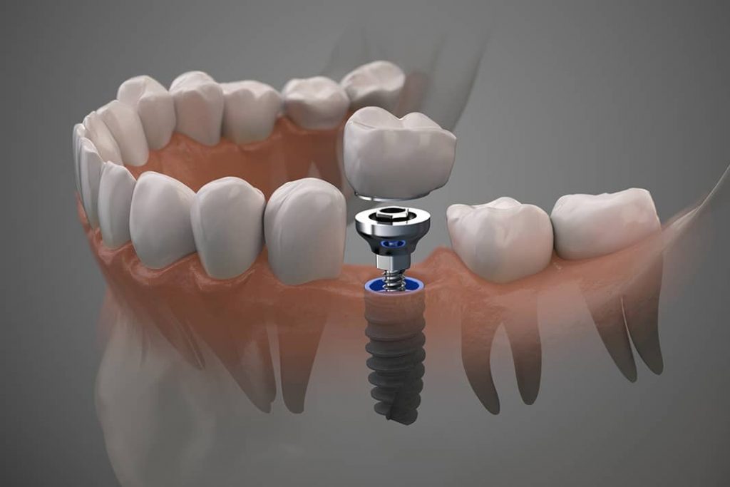 مراحل سه بعدی ایمپلنت دندان