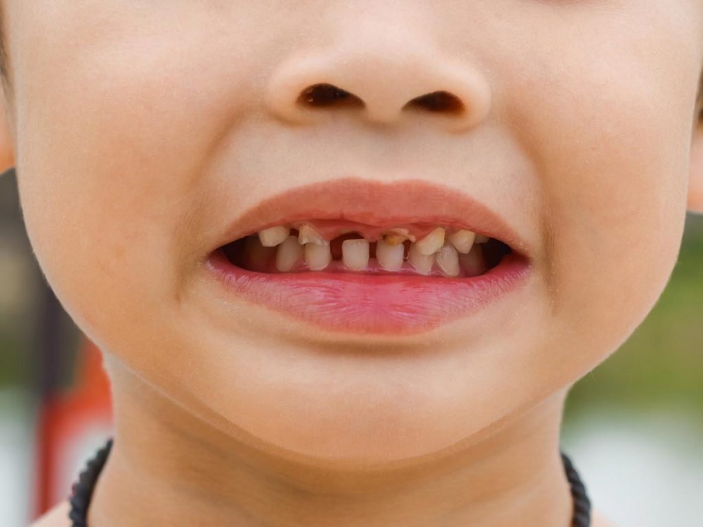 پوسیدگی دندان کودکان