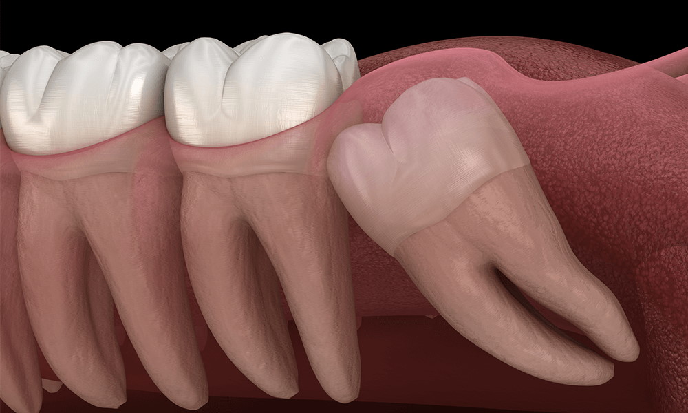 جراحی دندان عقل (جراحی دندان نهفته)