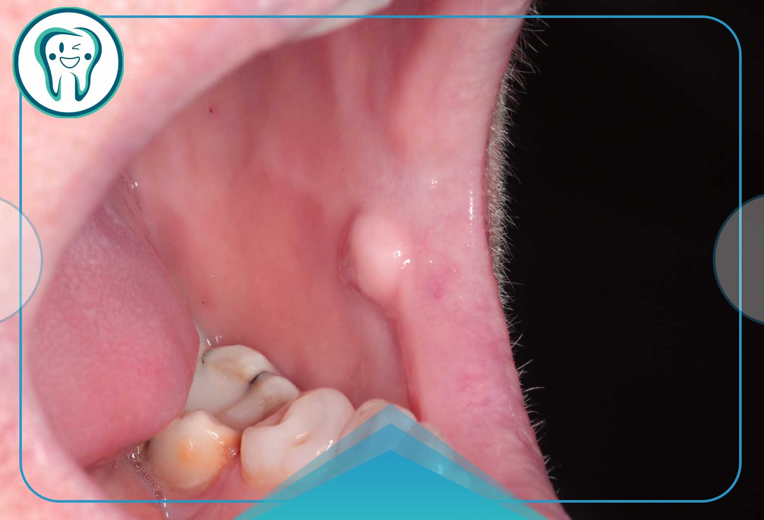 تشخیص فیبروم دهان