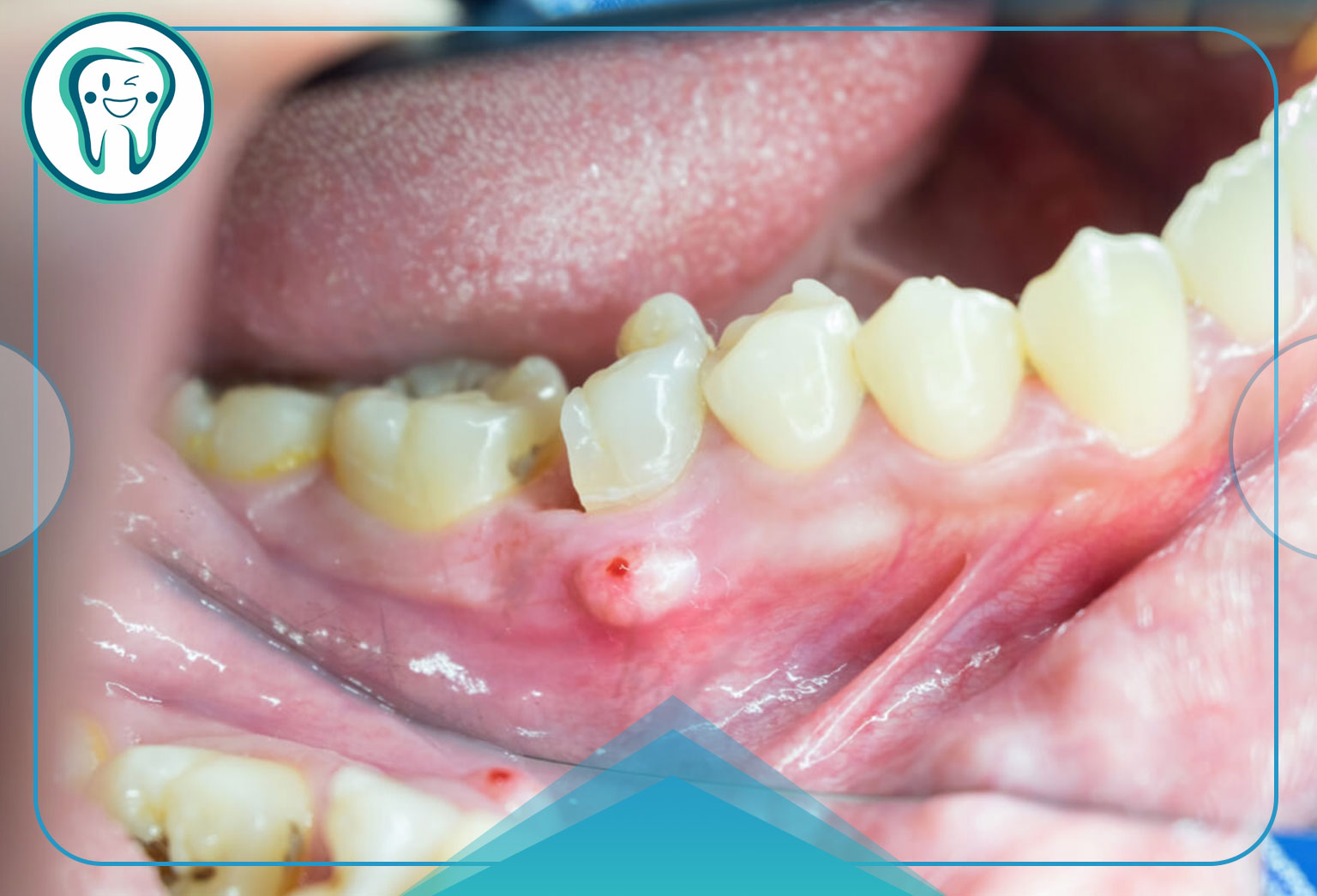 آیا آبسه دندان در خانه قابل درمان است؟