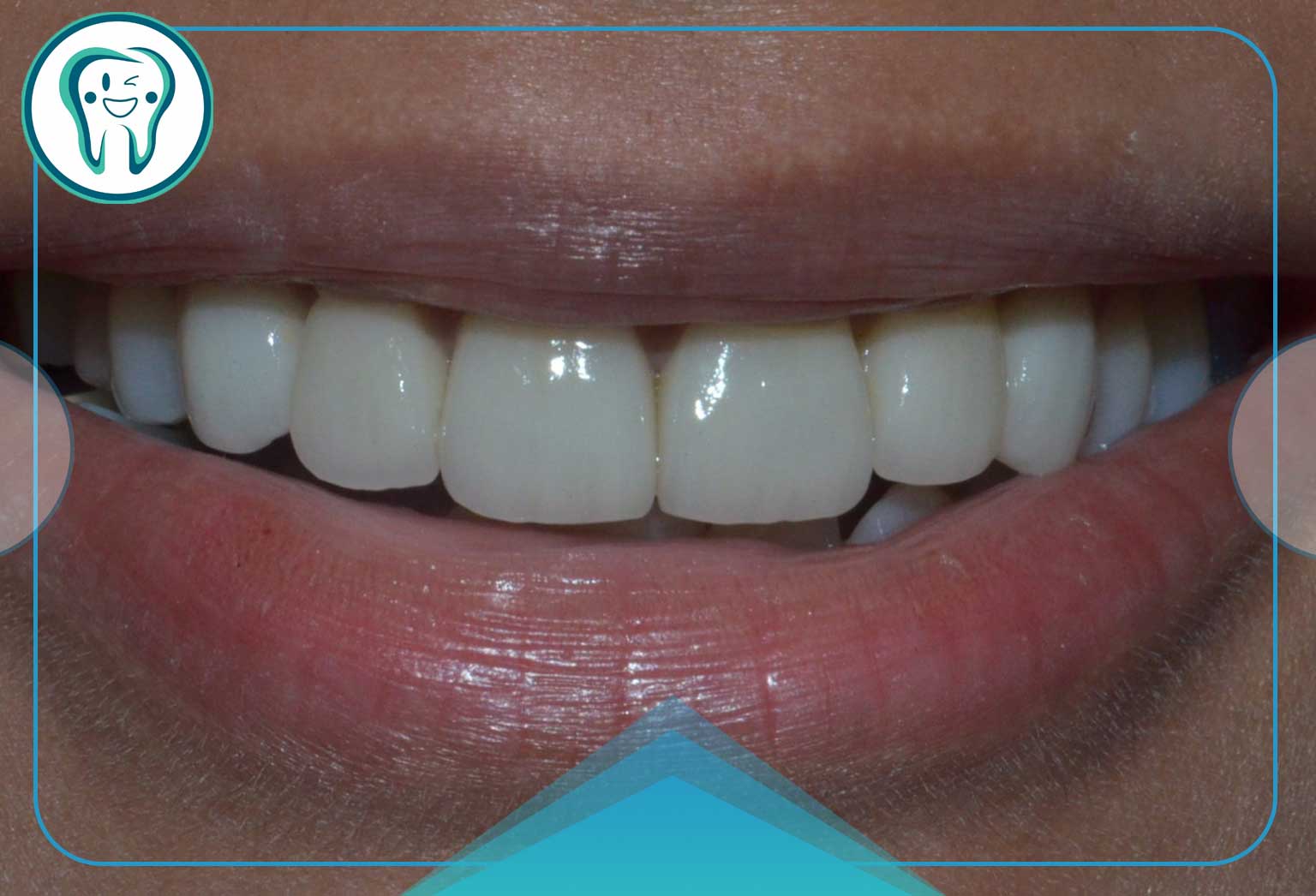 فرایند لمینت مستقیم ونیر دندان چیست؟