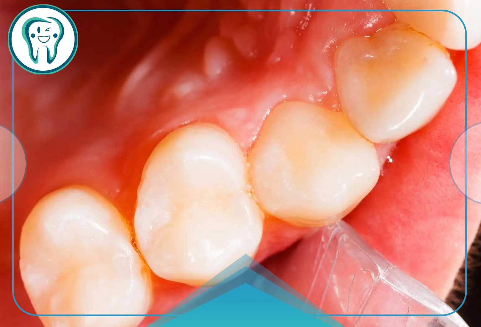 فرسایش ایدیوپاتیک دندان چیست؟