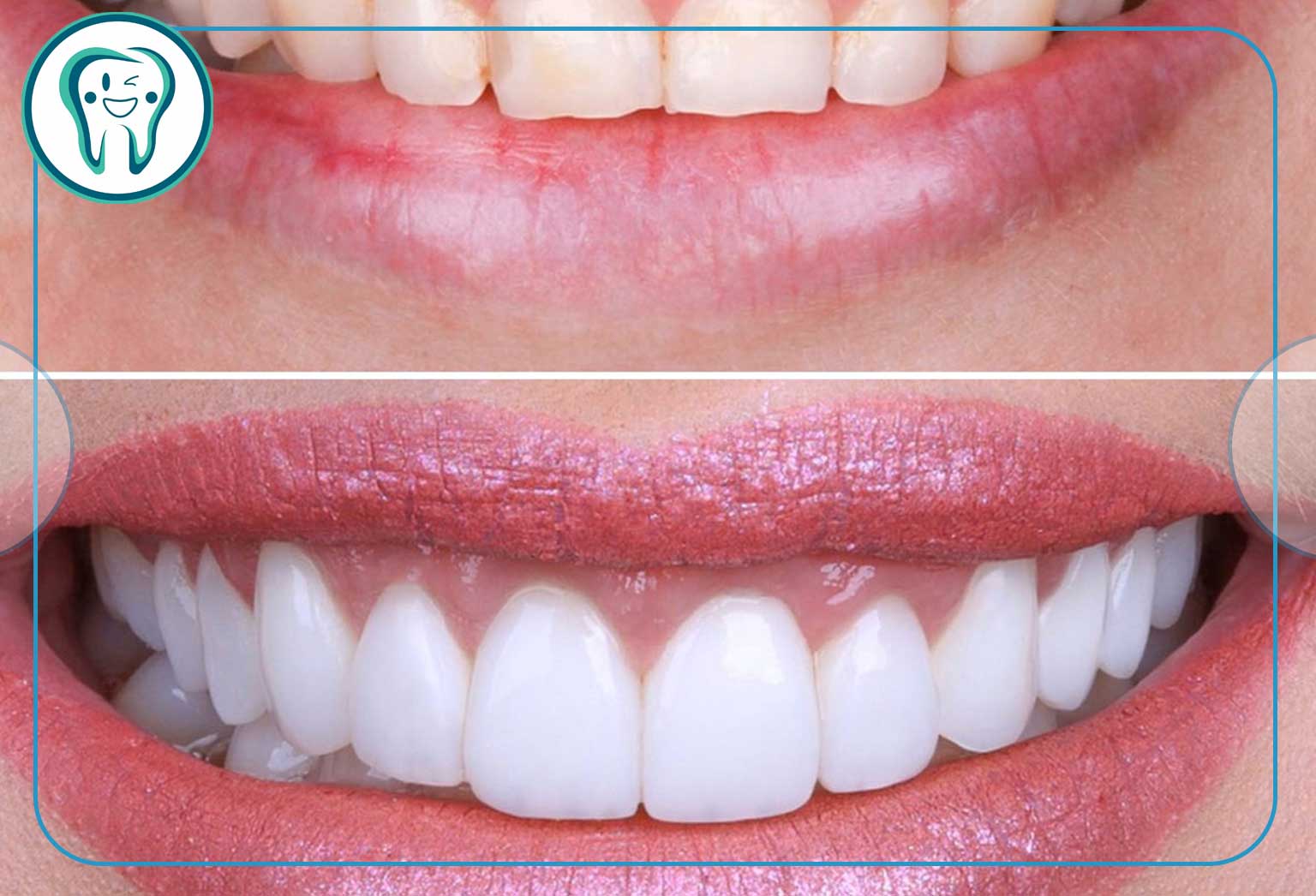 قبل و بعد نحوه نصب روکش دندان ایمکس