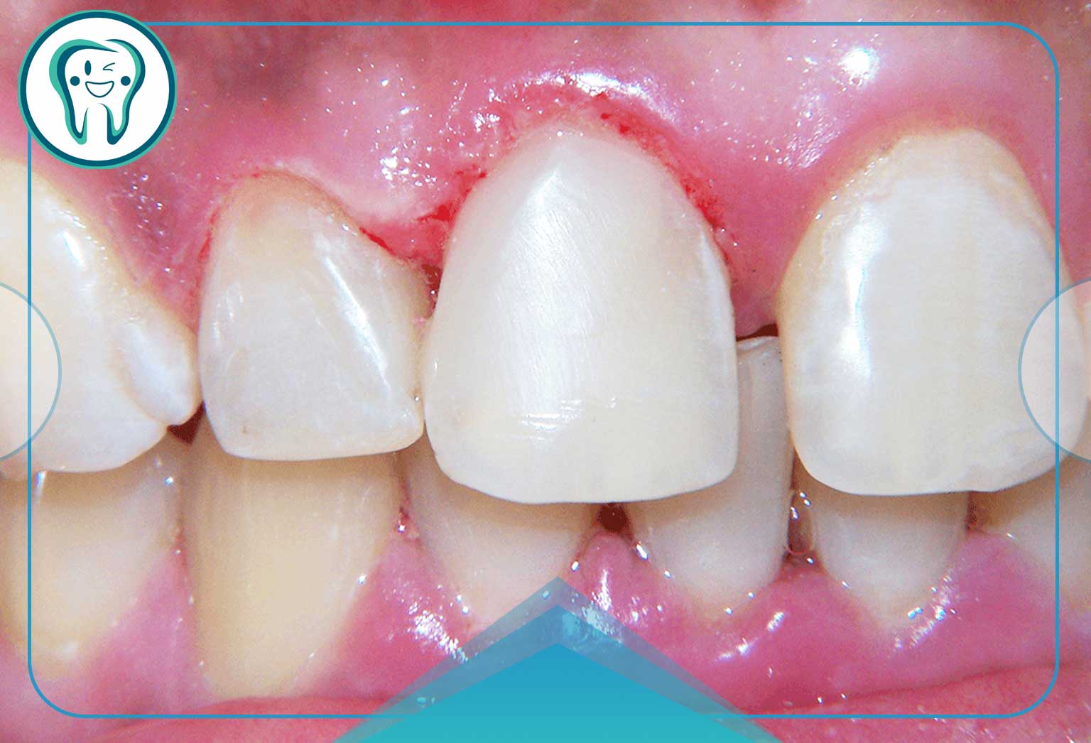 درمان فرسایش مینای دندان