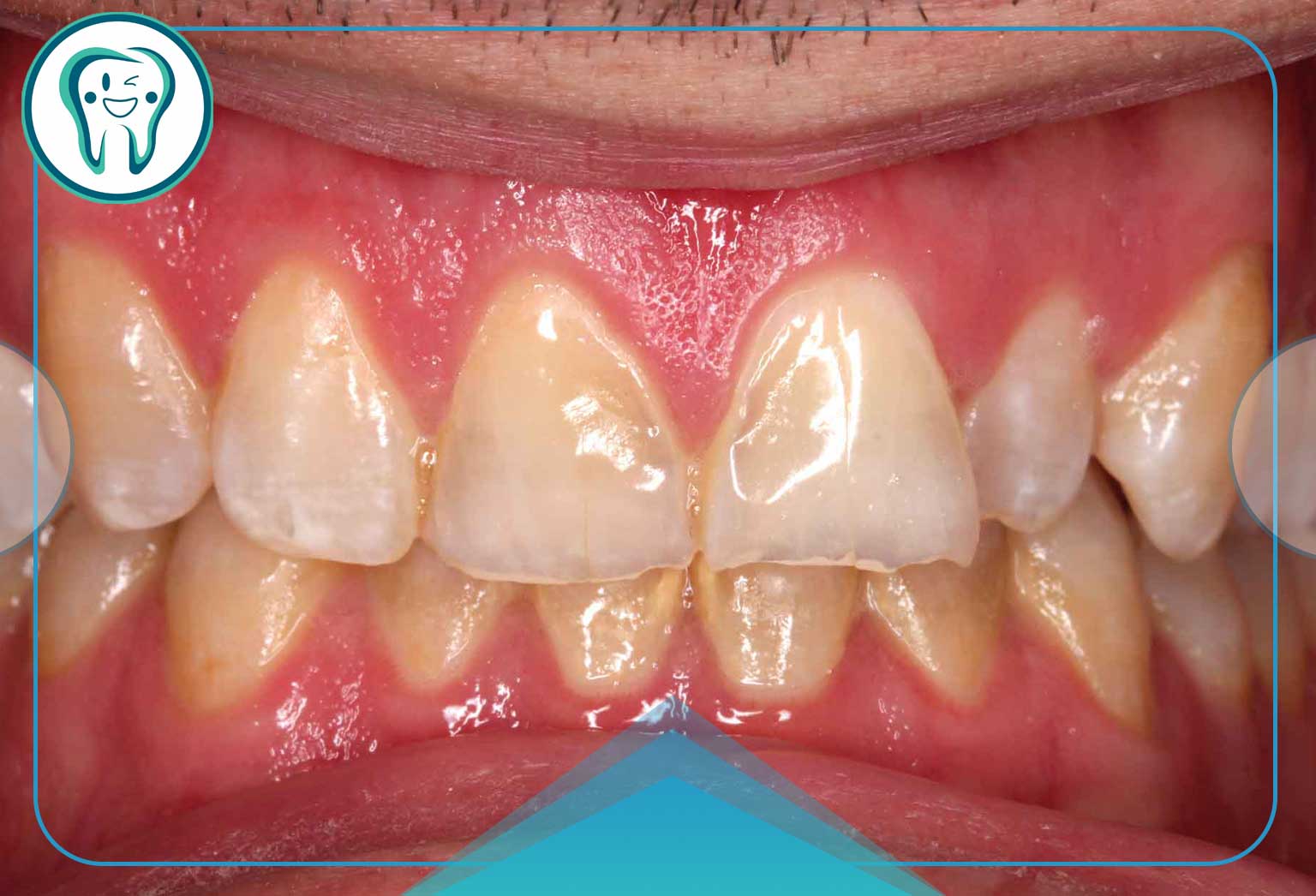 10 علت اصلی فرسایش مینای دندان