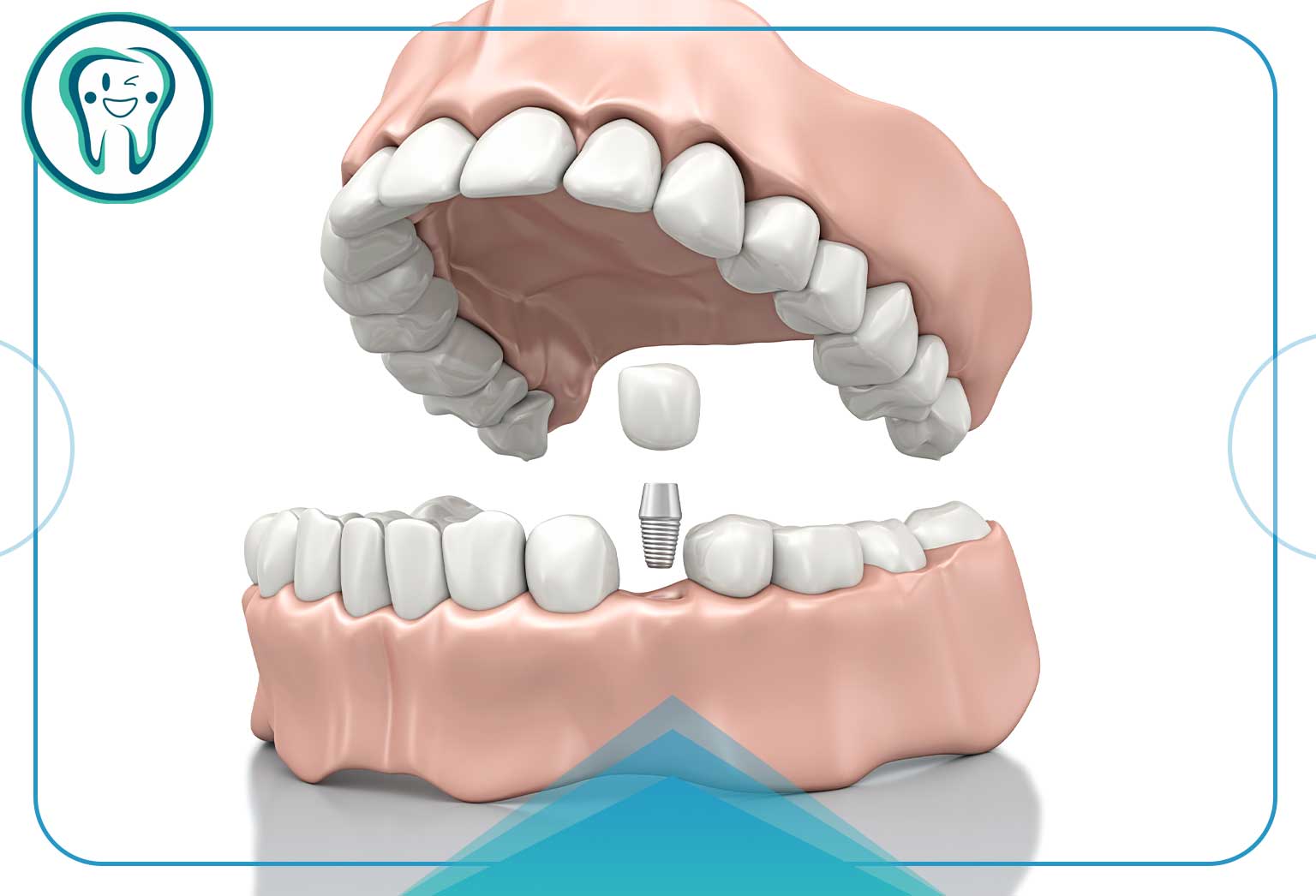 مزایای درمان ایمپلنت دندان