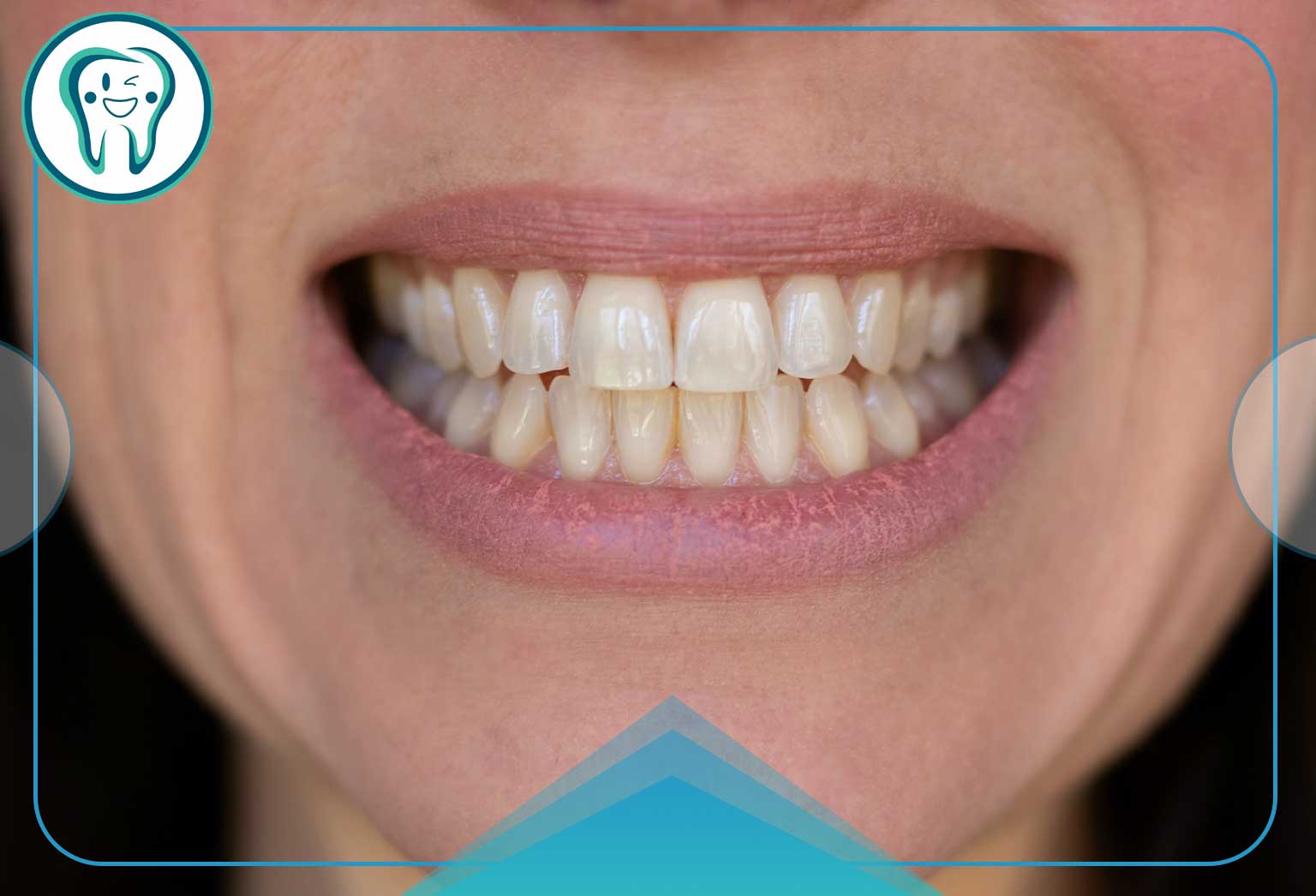 عوارض بلیچینگ دندان چیست؟