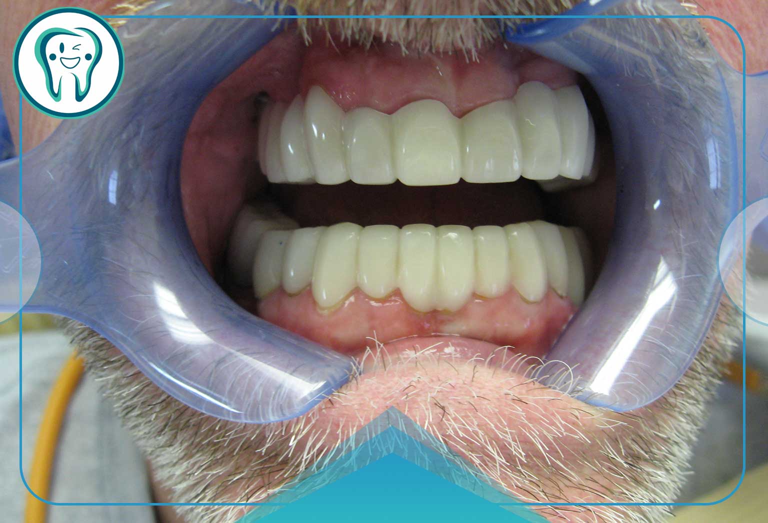 مشکلاتی که ممکن است در دندان طبیعی با انجام کامپوزیت واحدی 200 هزار تومانی  شده ایجاد شود: