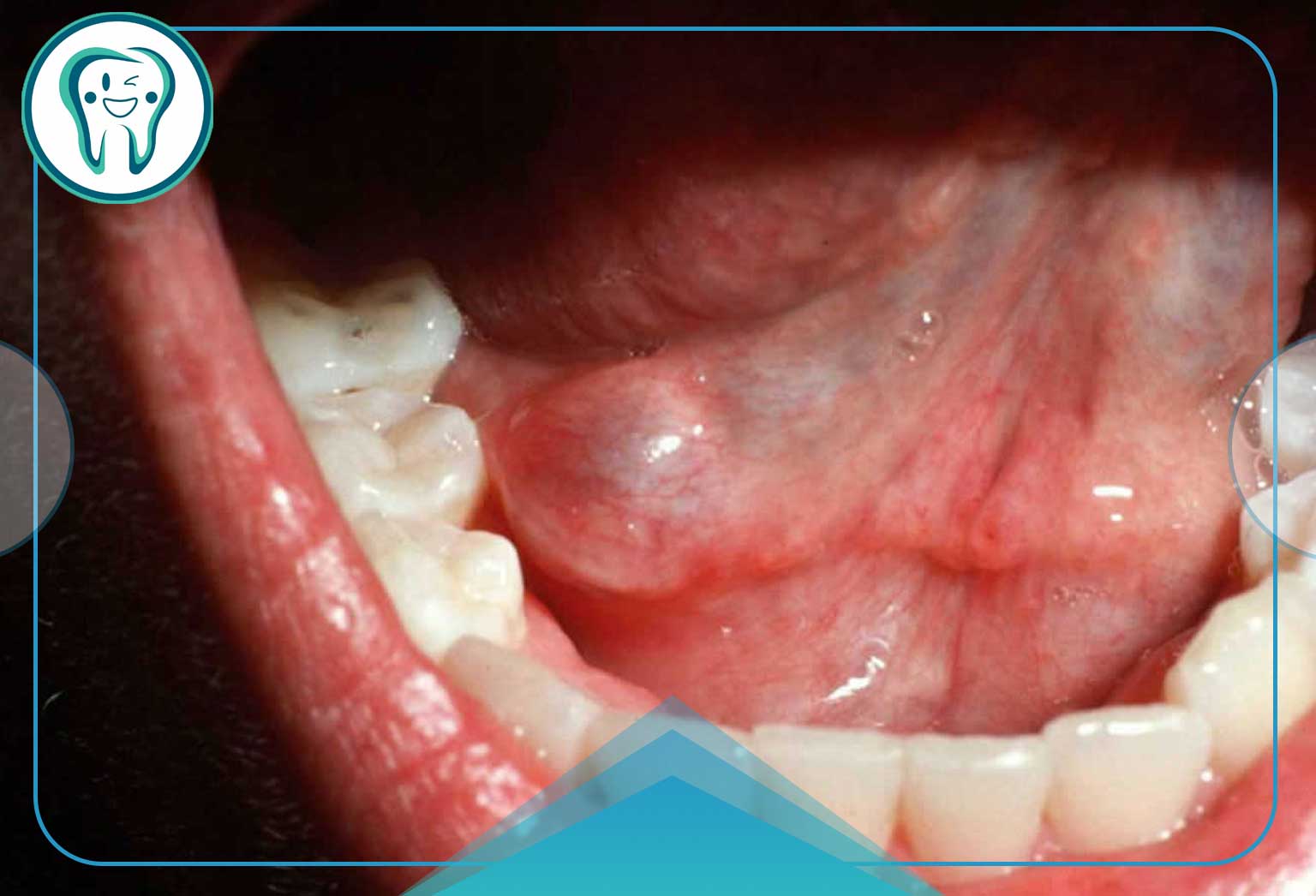 روش‌های درمان موکوسل (کیست دهان و لب)