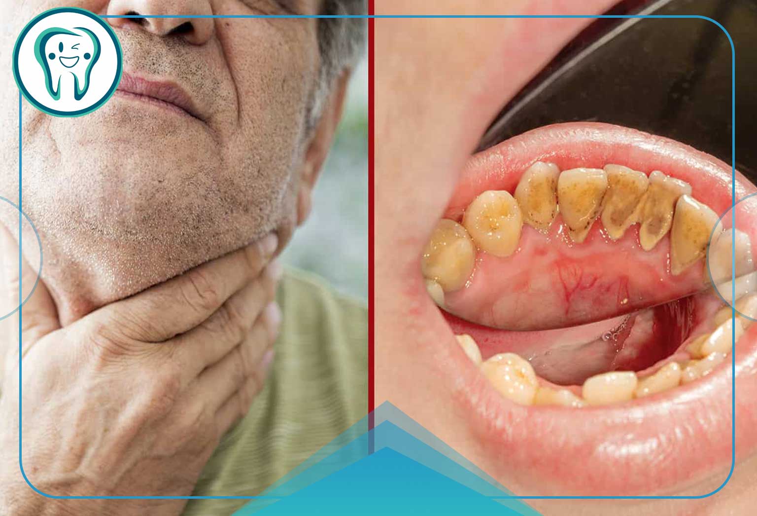 علائم و نشانه‌های سرطان دهان