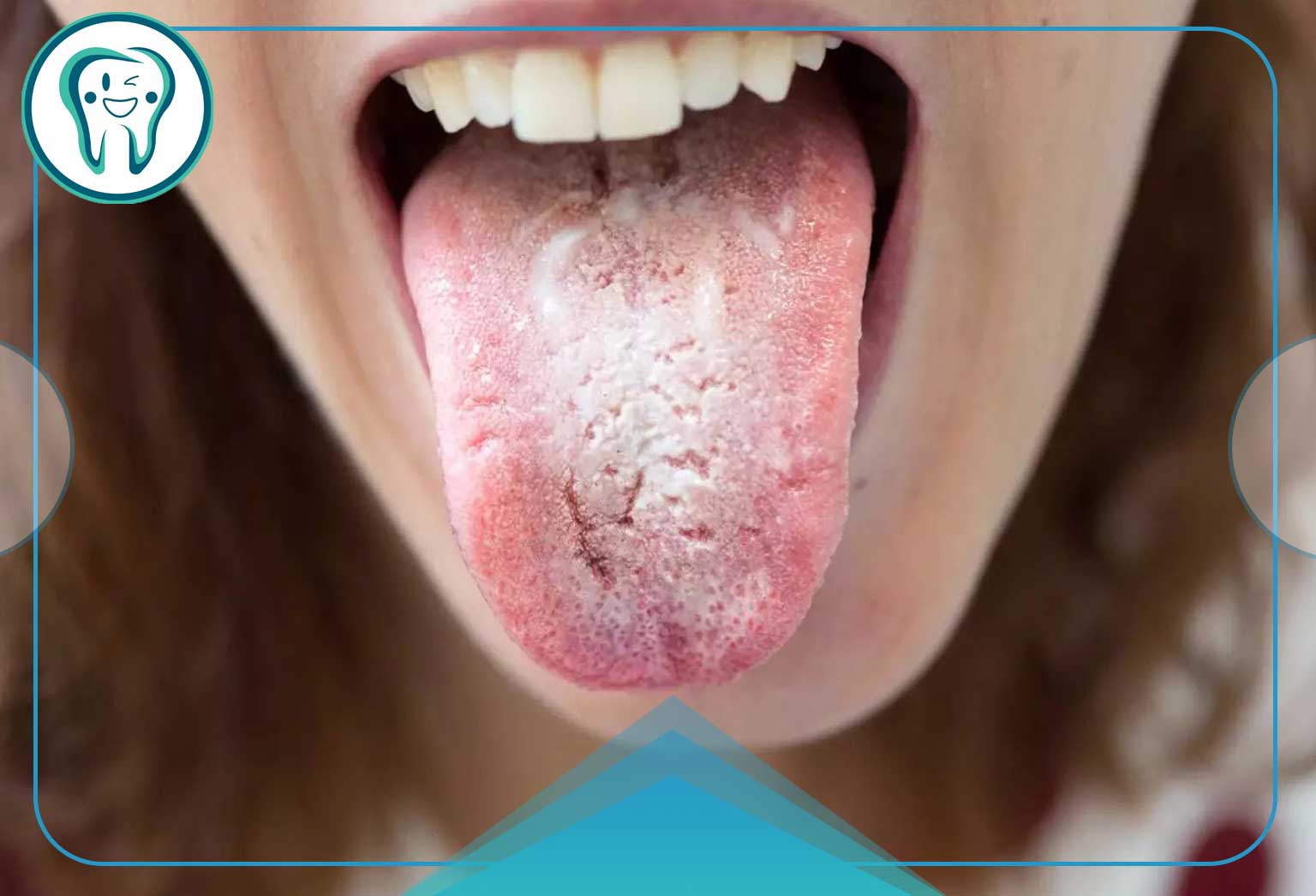 التهاب دندان و زبان