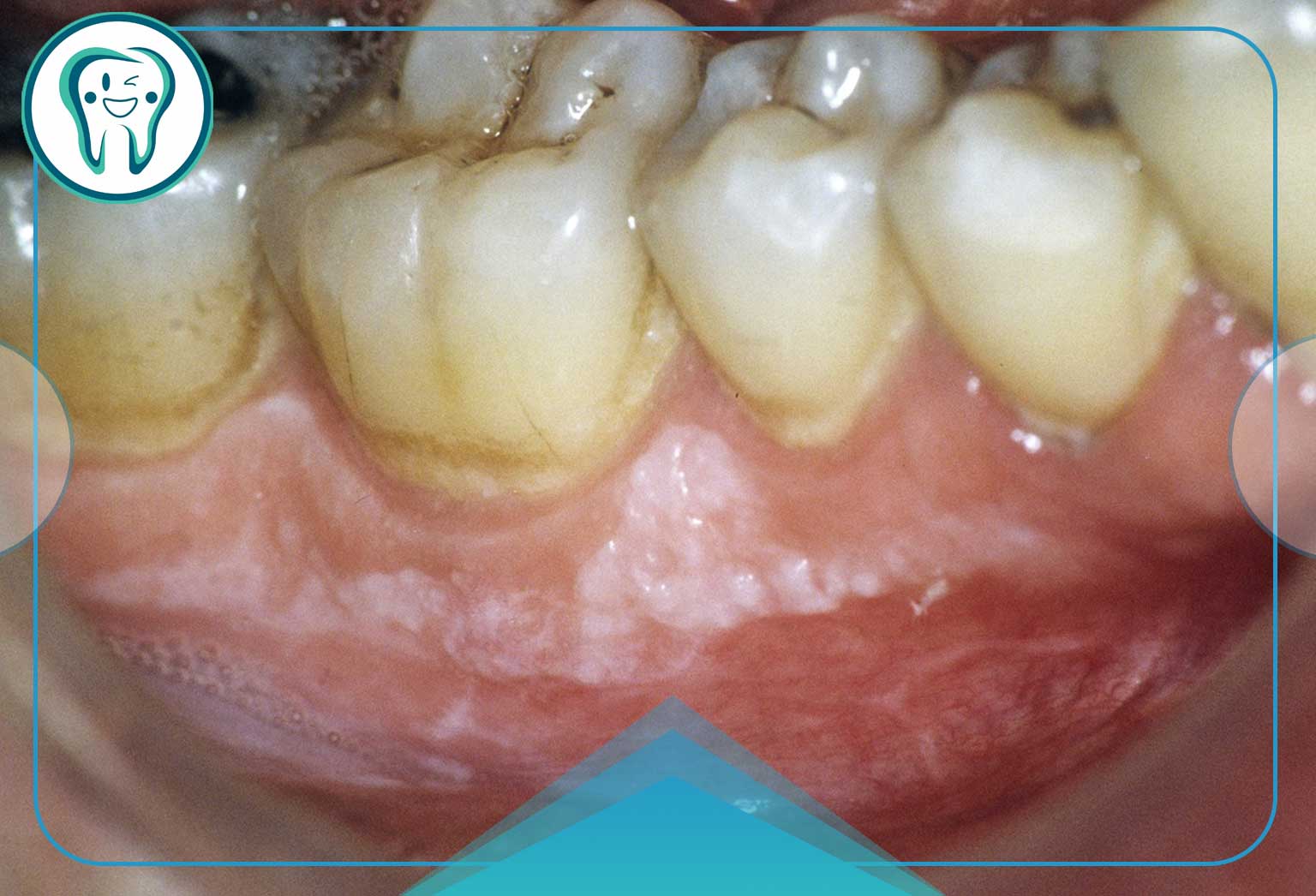 عوارض التهاب درمان نشده دندان