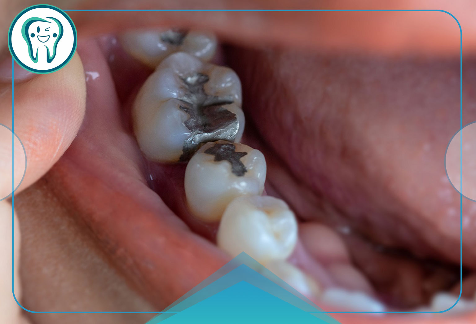 آیا پر کردن دندان معیوب می‌تواند باعث عفونت شود؟