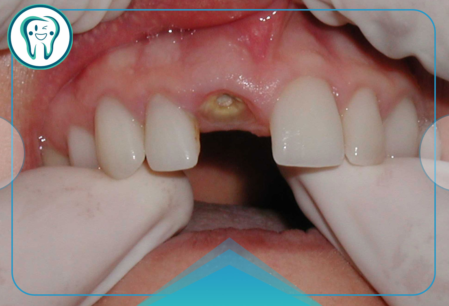 شناسایی آسیب های دندانی که نیاز به درمان دارد