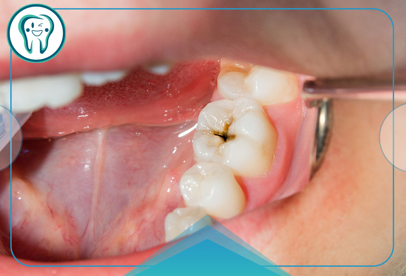 علائم پوسیدگی دندان در کودکان