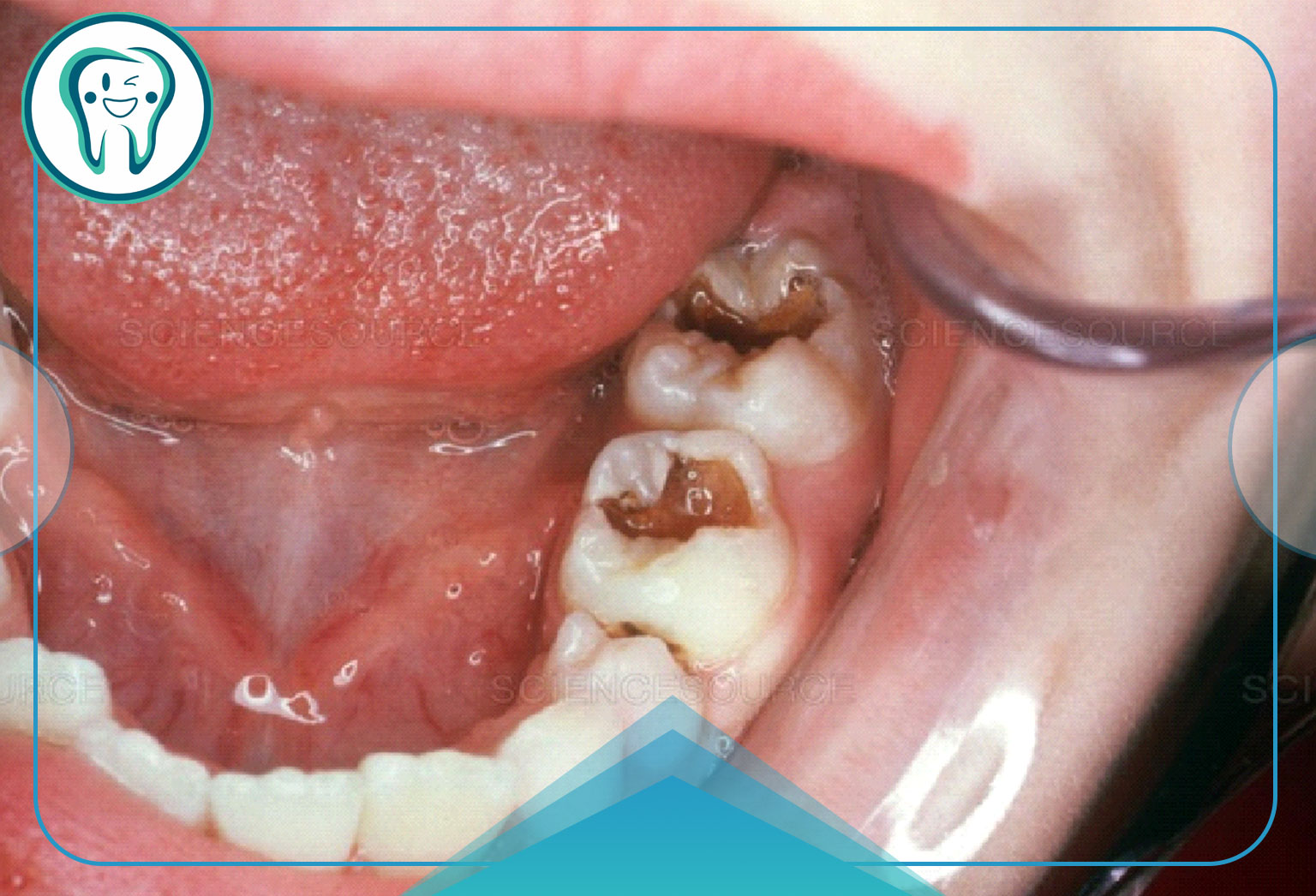 عوارض پوسیدگی دندان کودکان