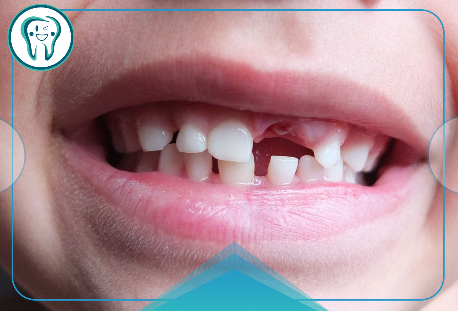 تأثیر ژنتیک در ایجاد پوسیدگی های دندانی