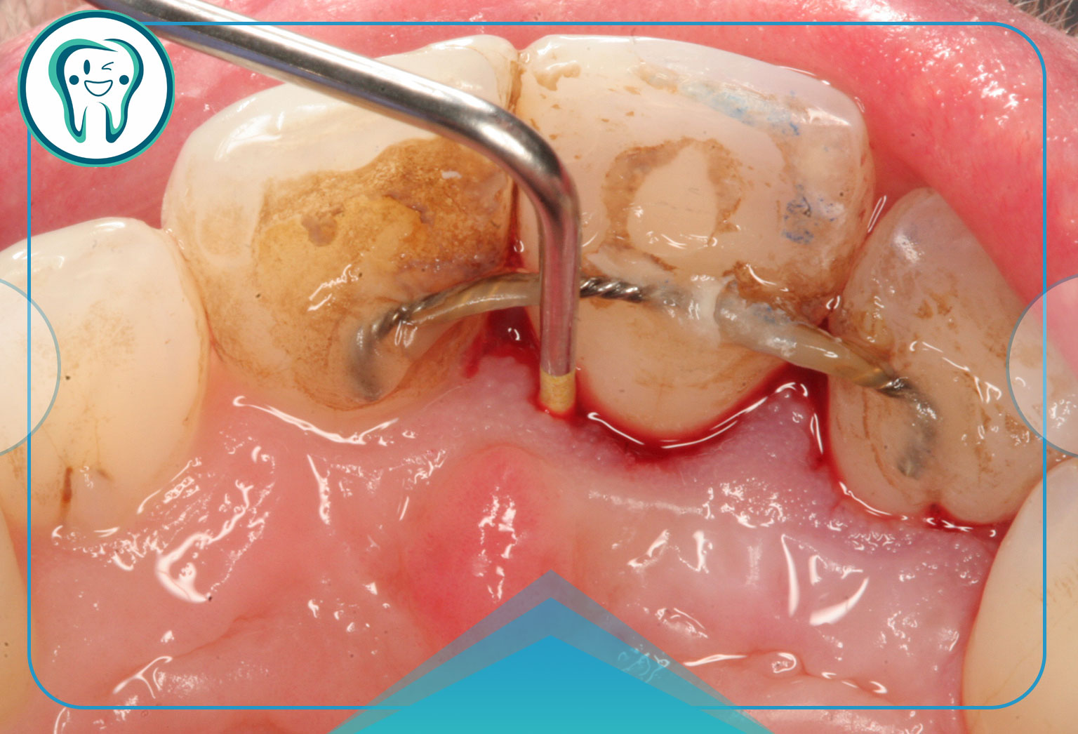 درمان‌های پزشکی عفونت دندان