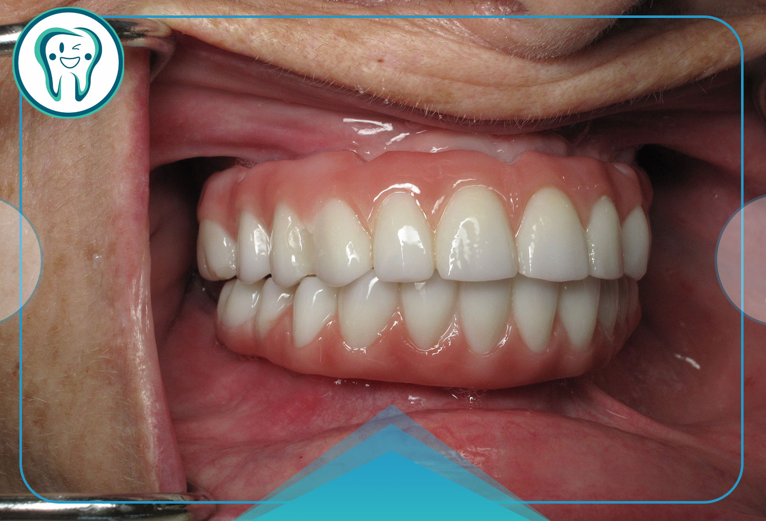 پروتز دندان ثابت روی ایمپلنت: