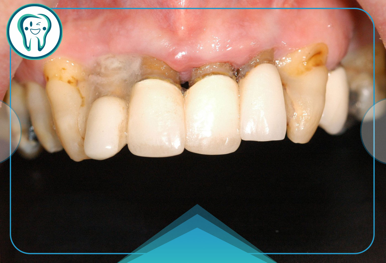 از کجا بفهمیم بریج دندان دچار آسیب شده است؟