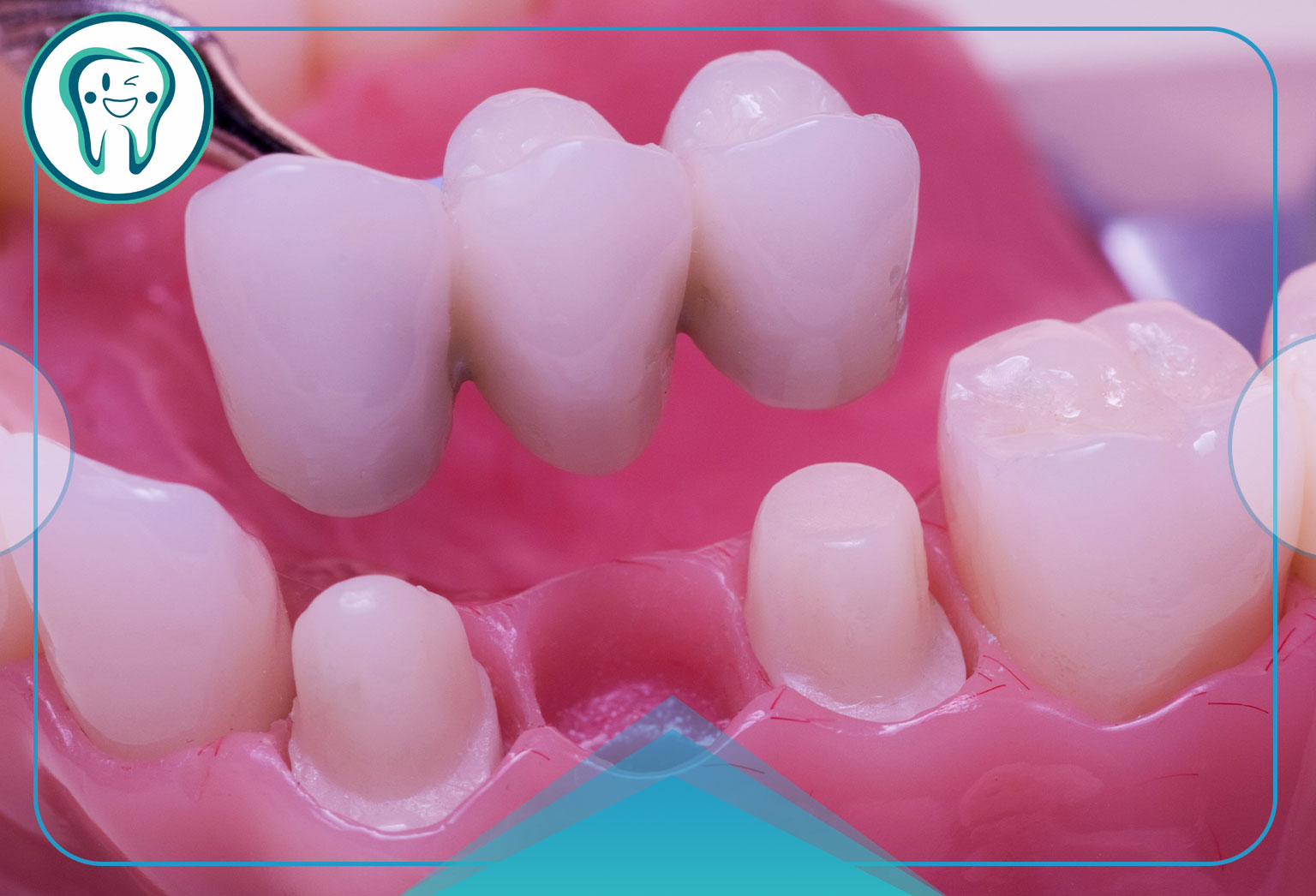 مواد سازنده پروتز ثابت دندان چیست؟