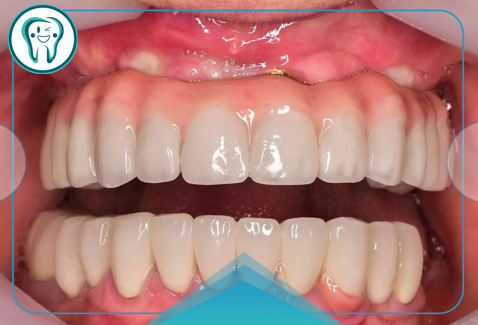 مزایای پروتزهای دندان ثابت:
