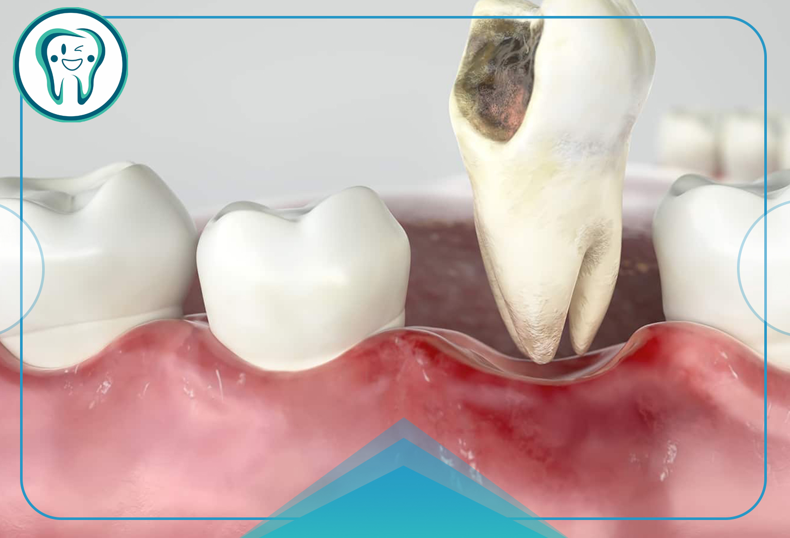 شرایط لثه و دهان بعد از کشیدن دندان