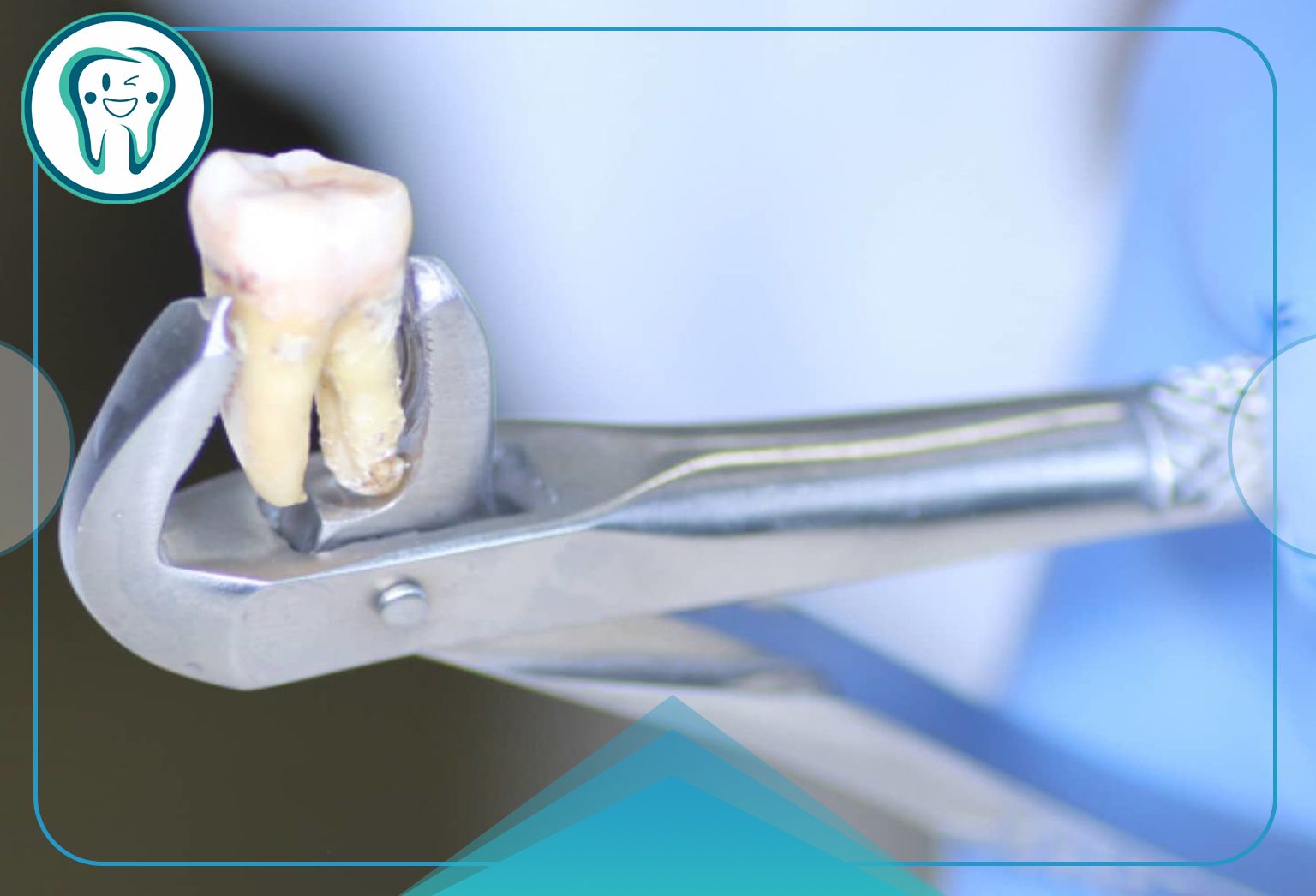 درد بعد از کشیدن دندان چقدر طول می‌کشد؟