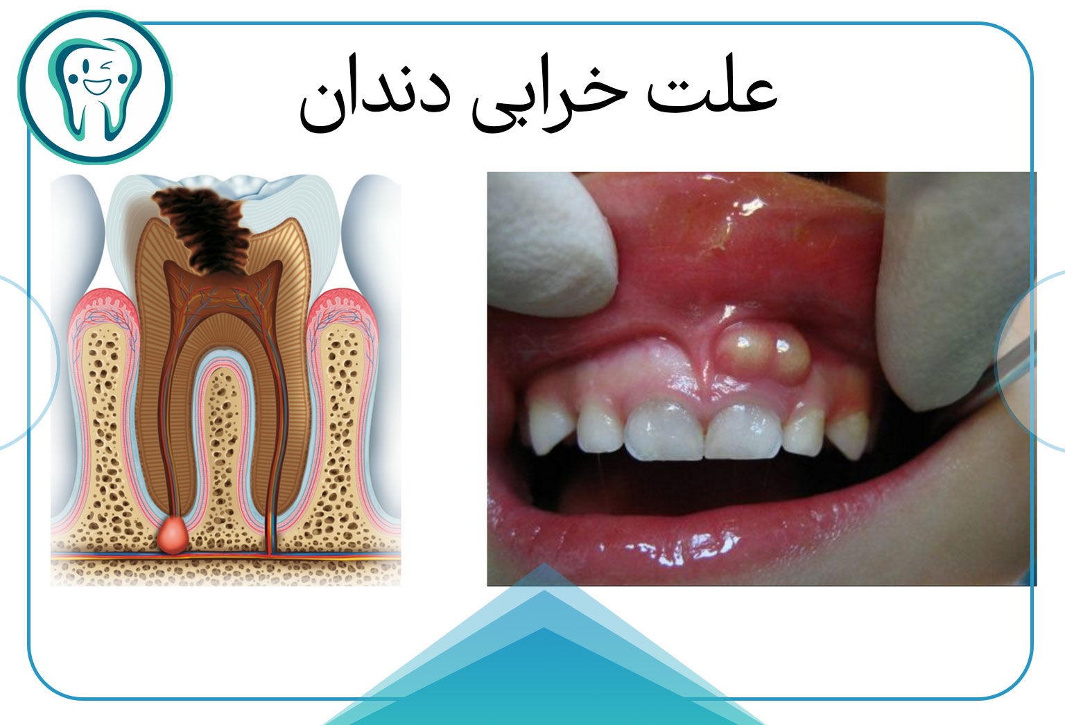 دلیل خراب شدن دندان‌ها چیست؟