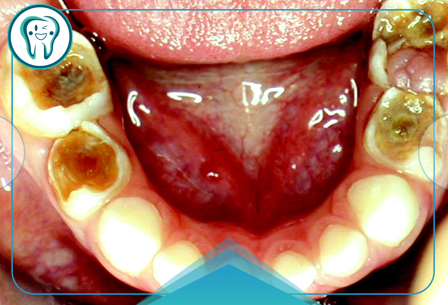 چه بیماری باعث خرابی دندان می‌شود؟