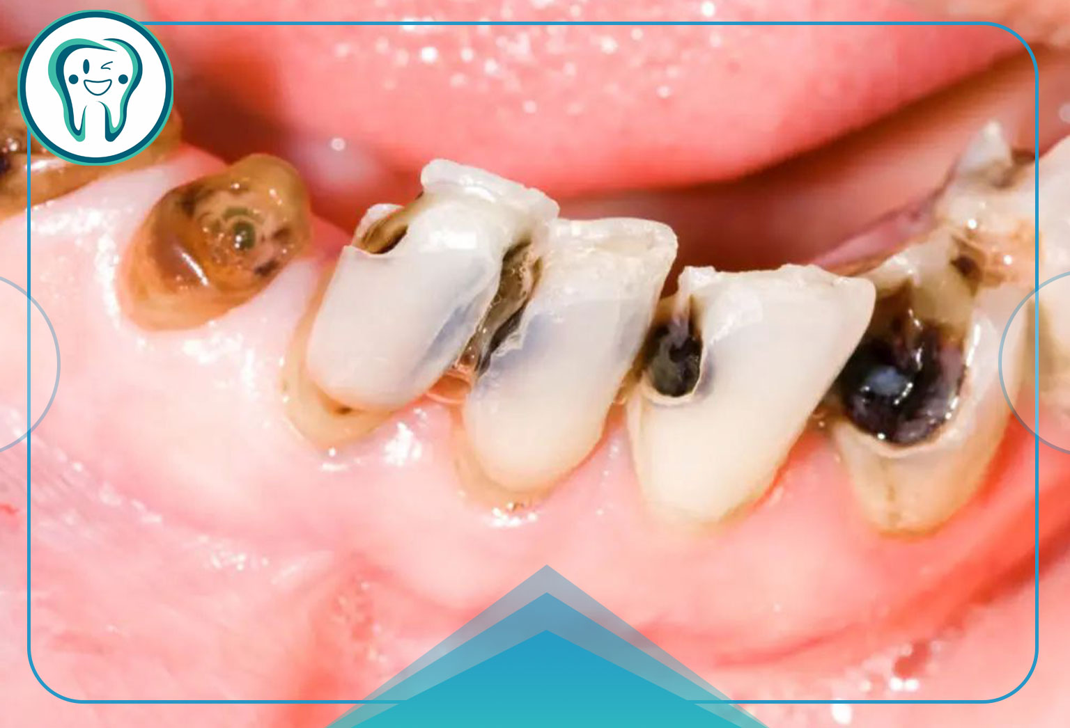 عواملی که احتمال پوسیدگی دندان را افزایش می دهد؟