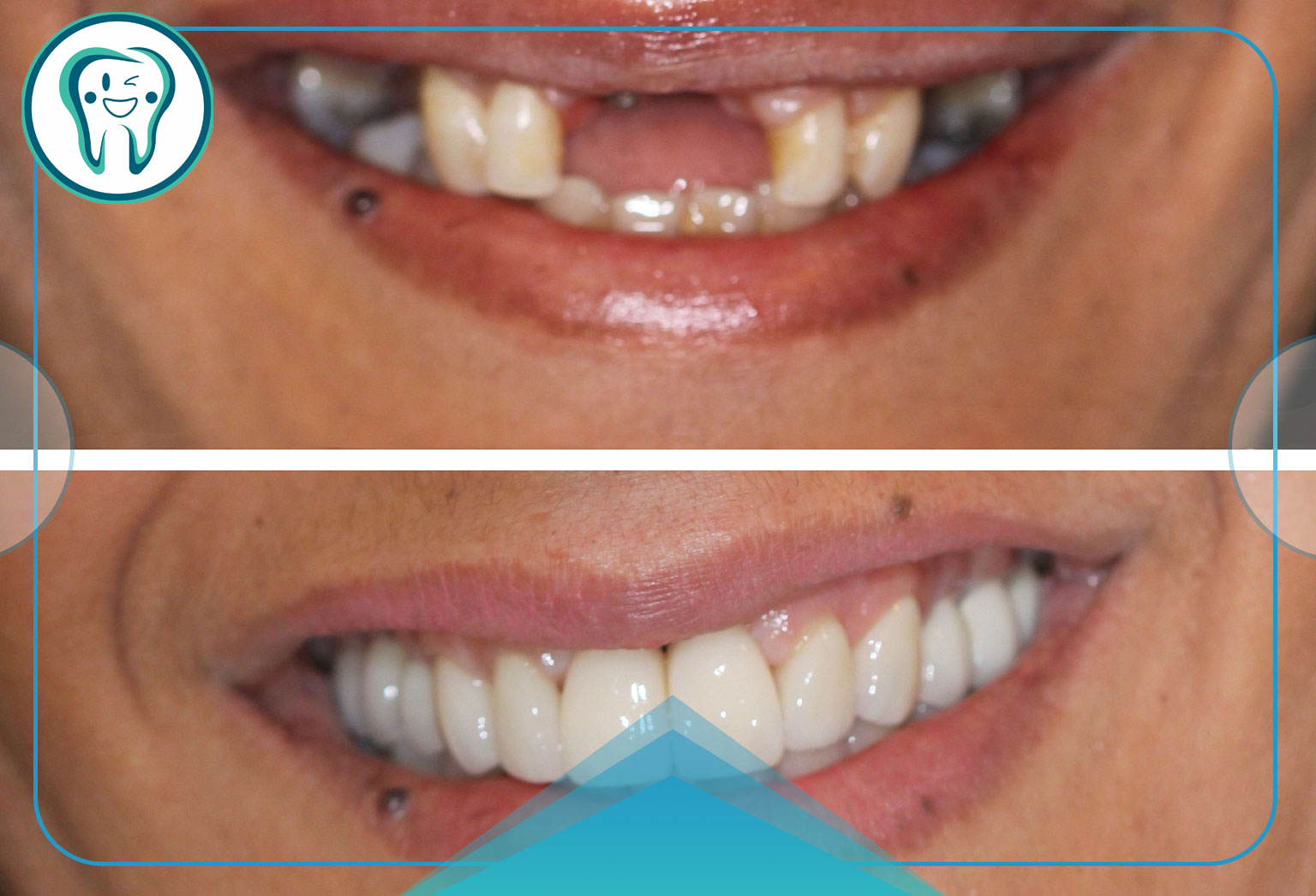 بهبودی طولانی مدت بعد از کشیدن دندان