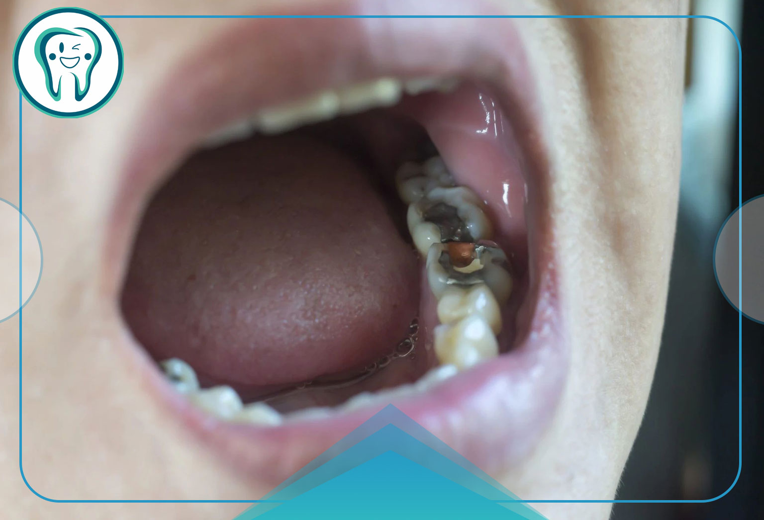 درمان دندان درد با زردچوبه
