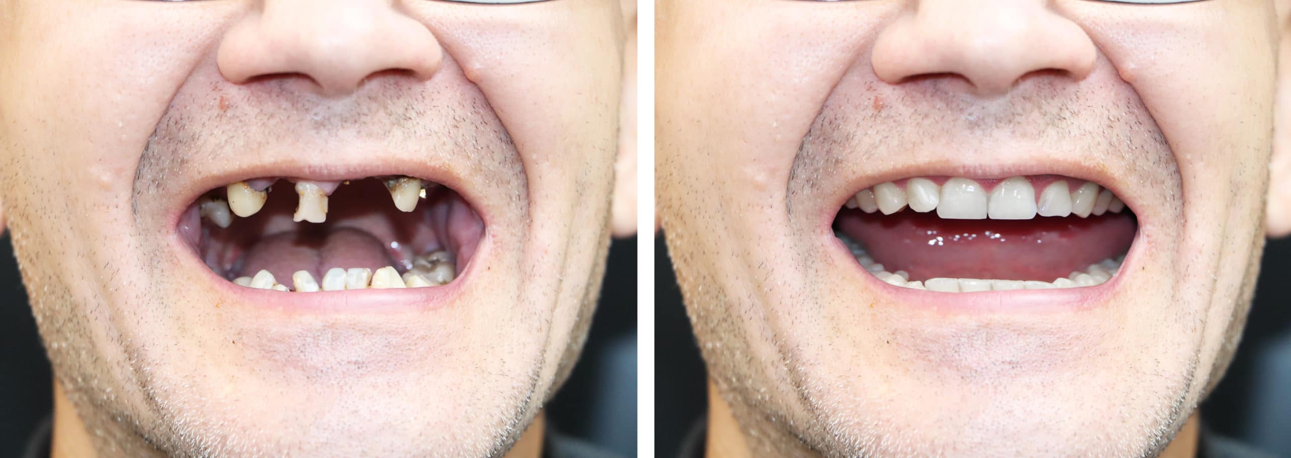 آماده سازی برای قرار دادن دندان مصنوعی بعد از کشیدن دندان