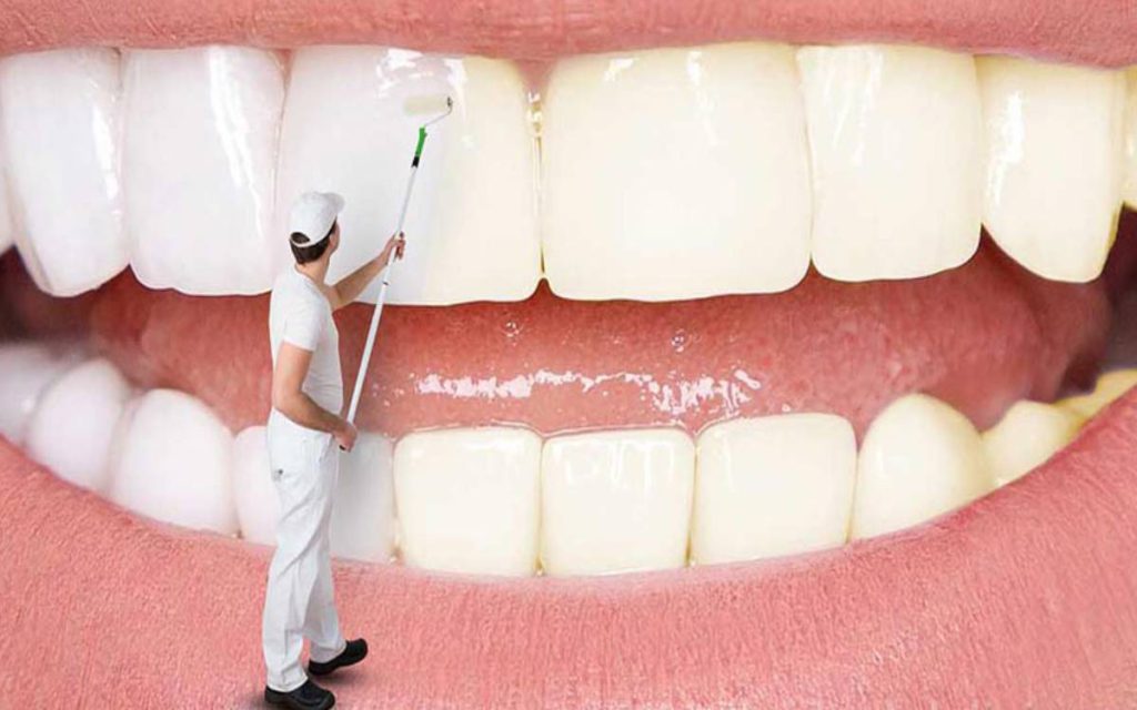 دندان سفید کردن