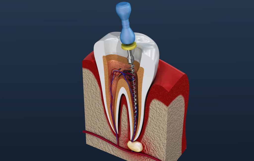 درمان ریشه در دندانپزشکی