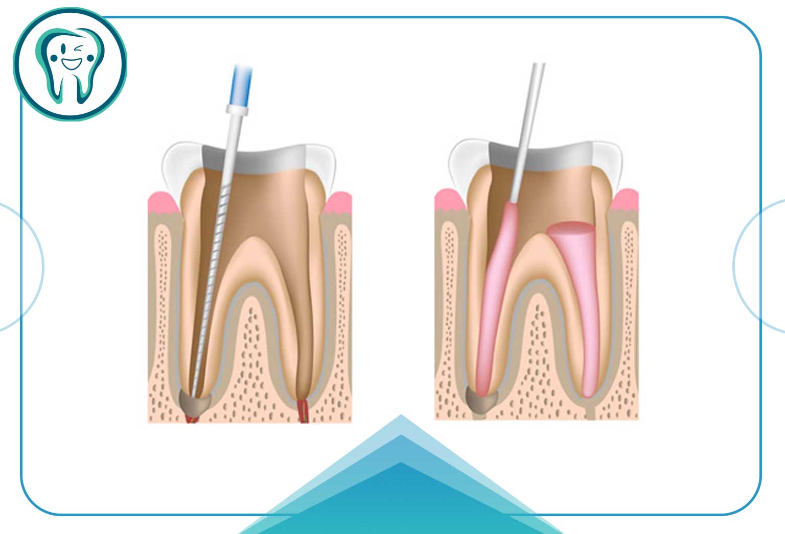 تمیز کردن و شکل دادن به کانال دندان