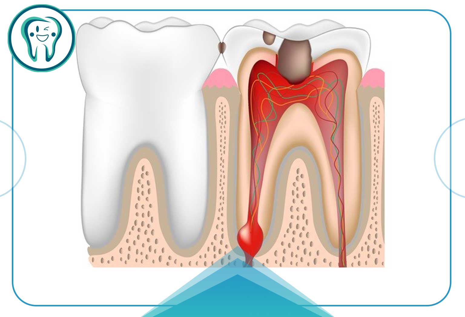 خطرات و عوارض عصب کشی دندان