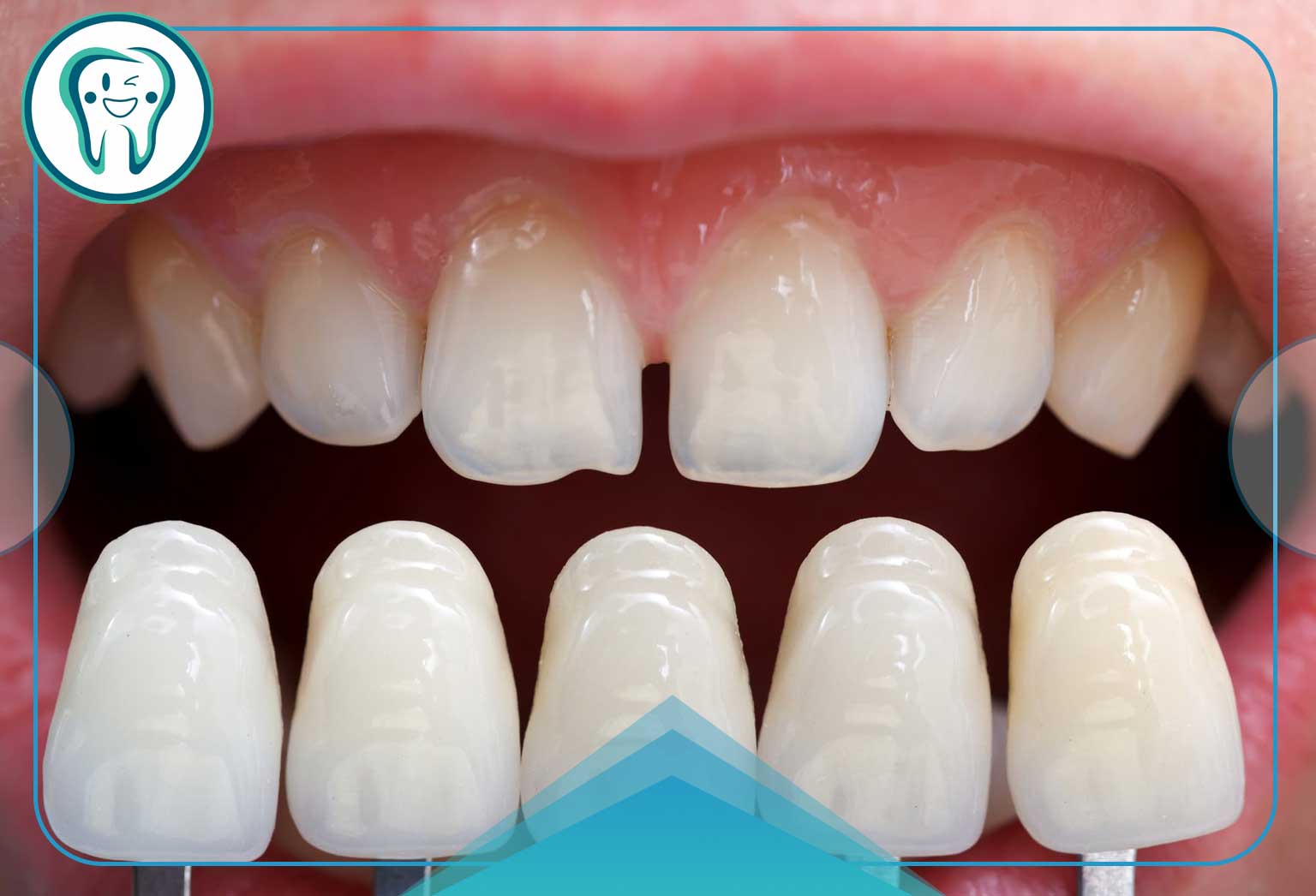 عوارض روکش دندان