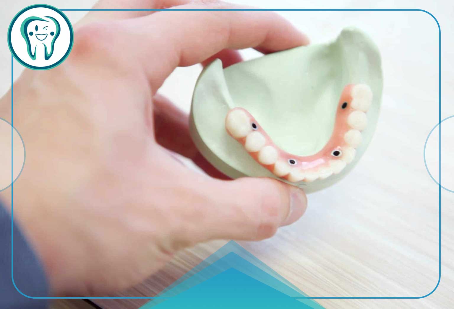 کم هزینه ترین روش ایمپلنت همه دندان ها