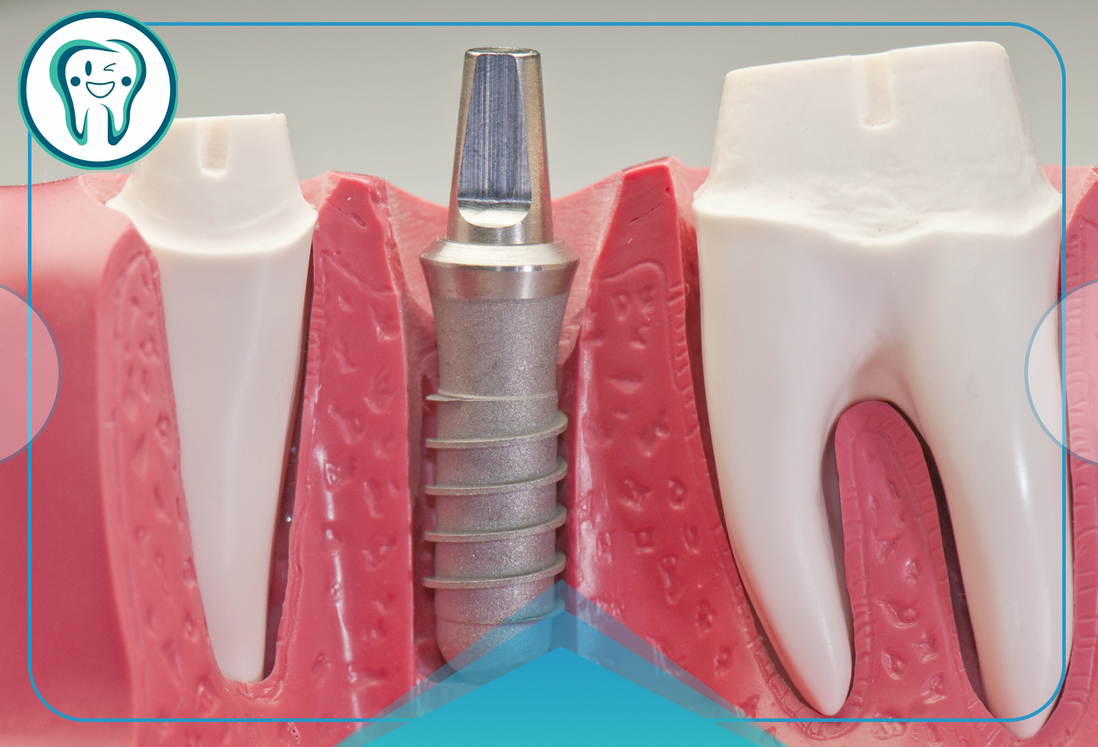 The use of dental implants in West Tehran