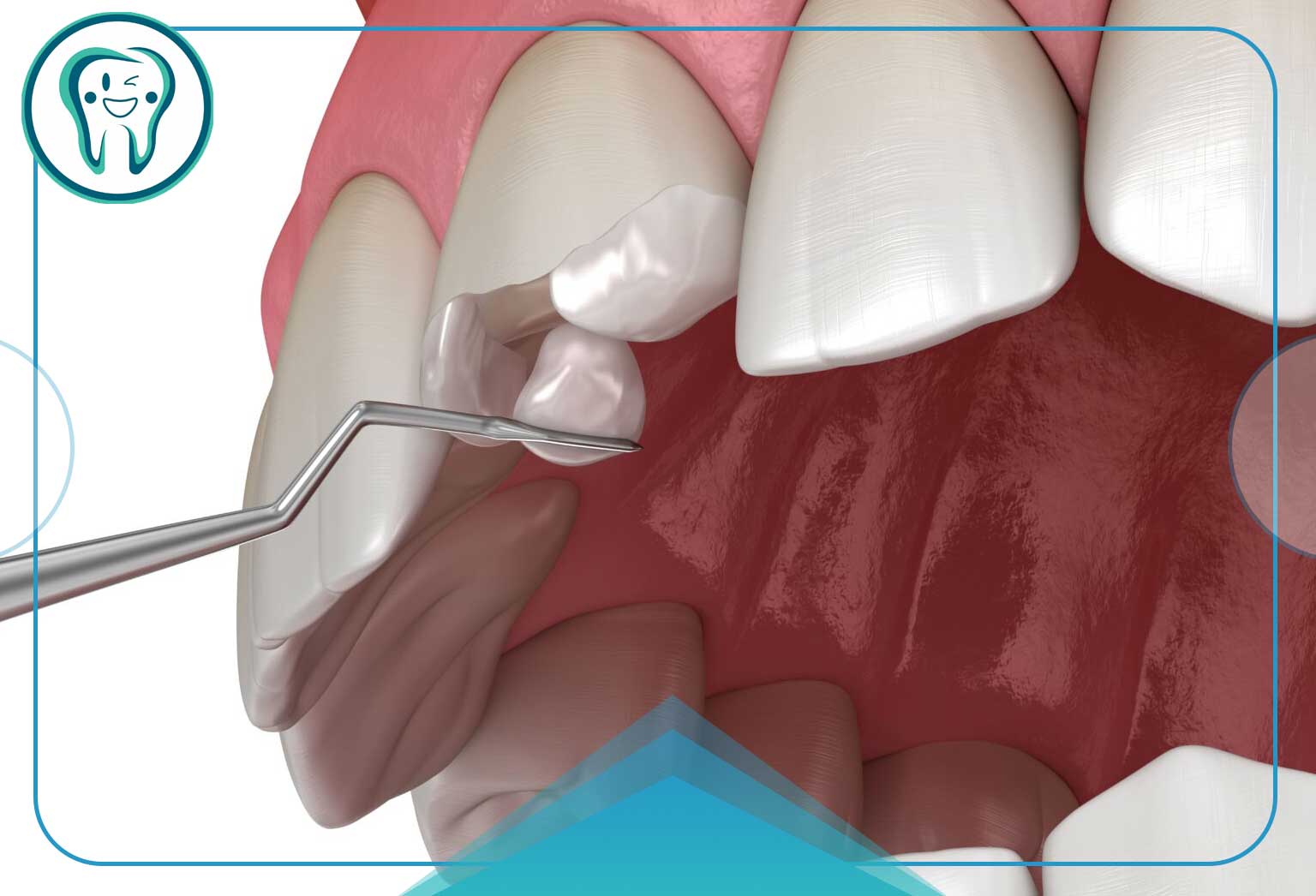 معایب و خطرات کامپوزیت دندان اقساطی در غرب تهران 