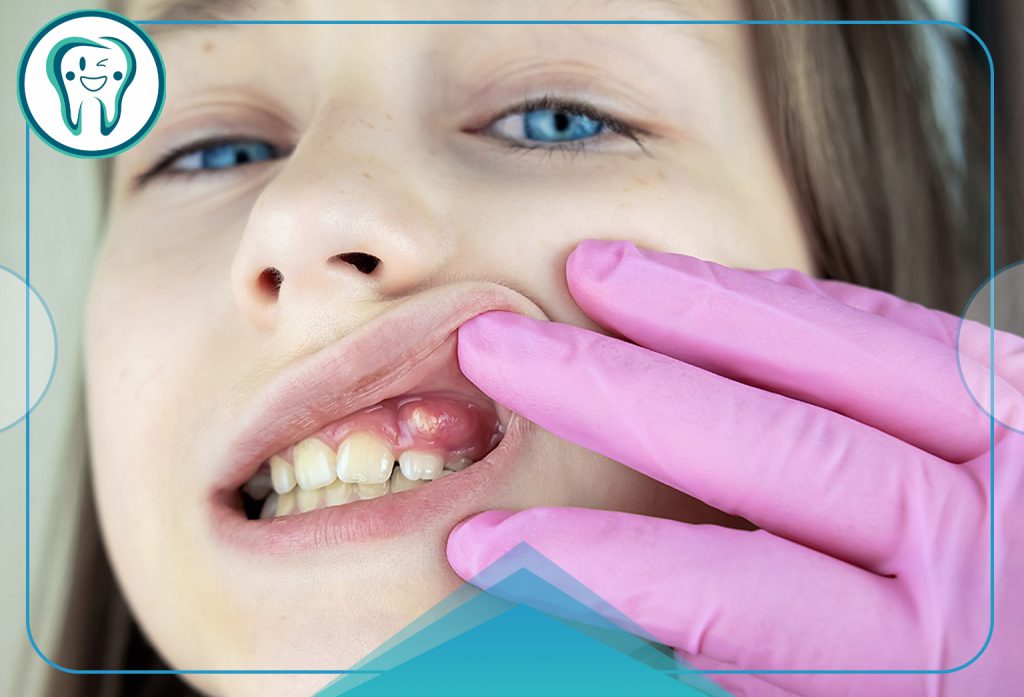 Oral abscess in children