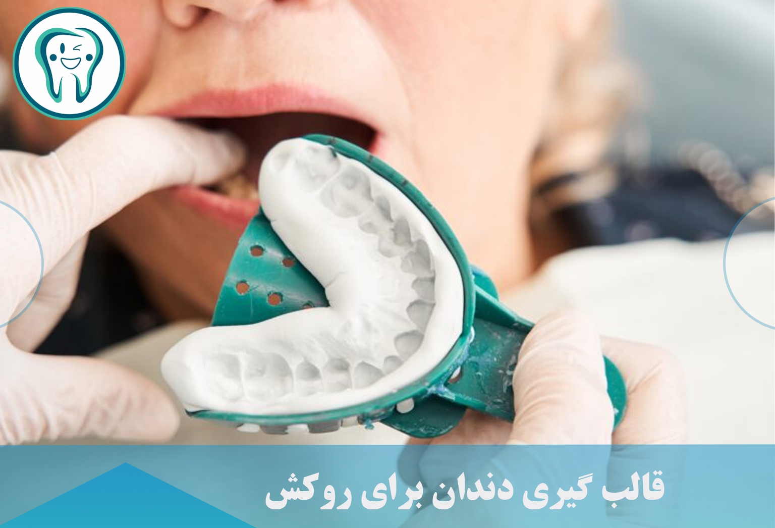 قالب گیری دندان برای روکش 