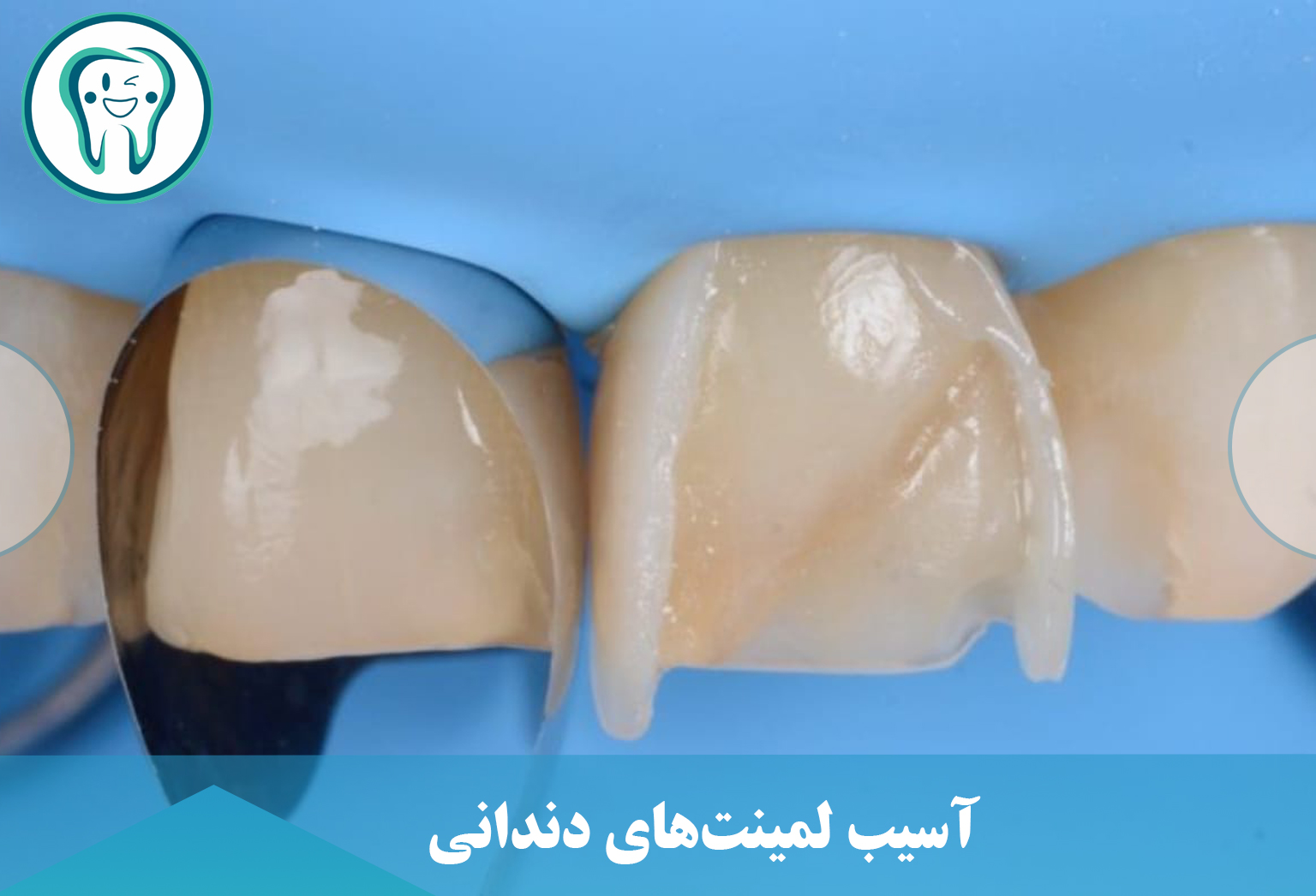 آسیب لمینت‌های دندانی 