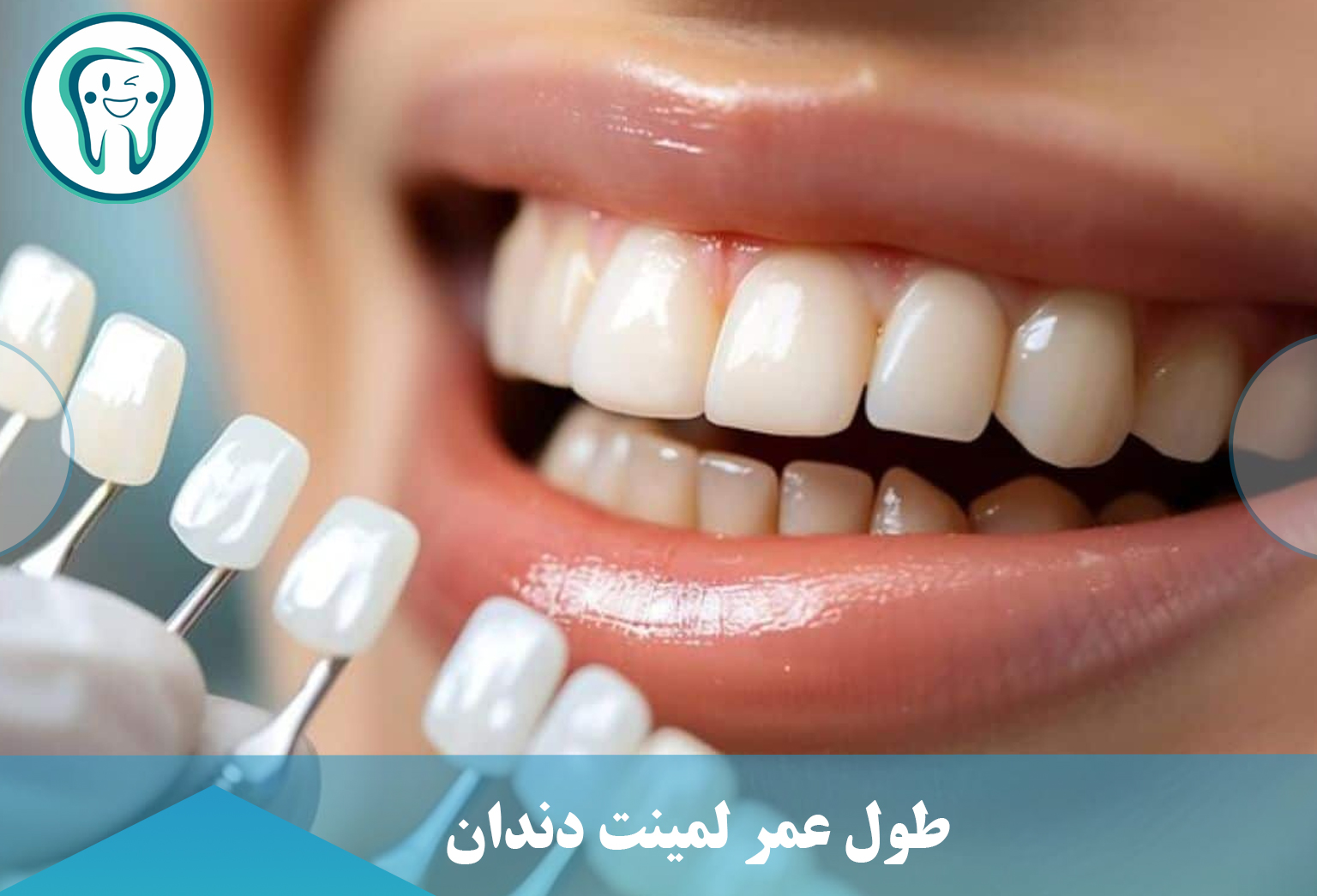 طول عمر لمینت‌ دندان