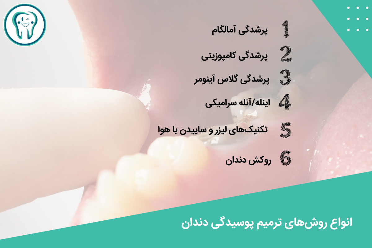 انواع روش‌های ترمیم پوسیدگی دندان
