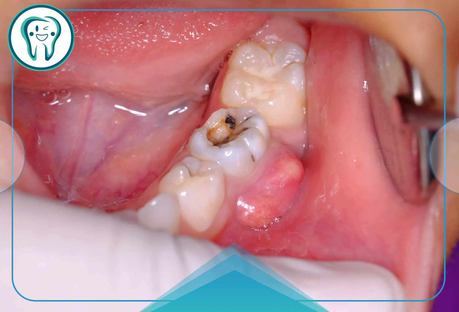 علل اصلی ریشه دندان عفونتی
