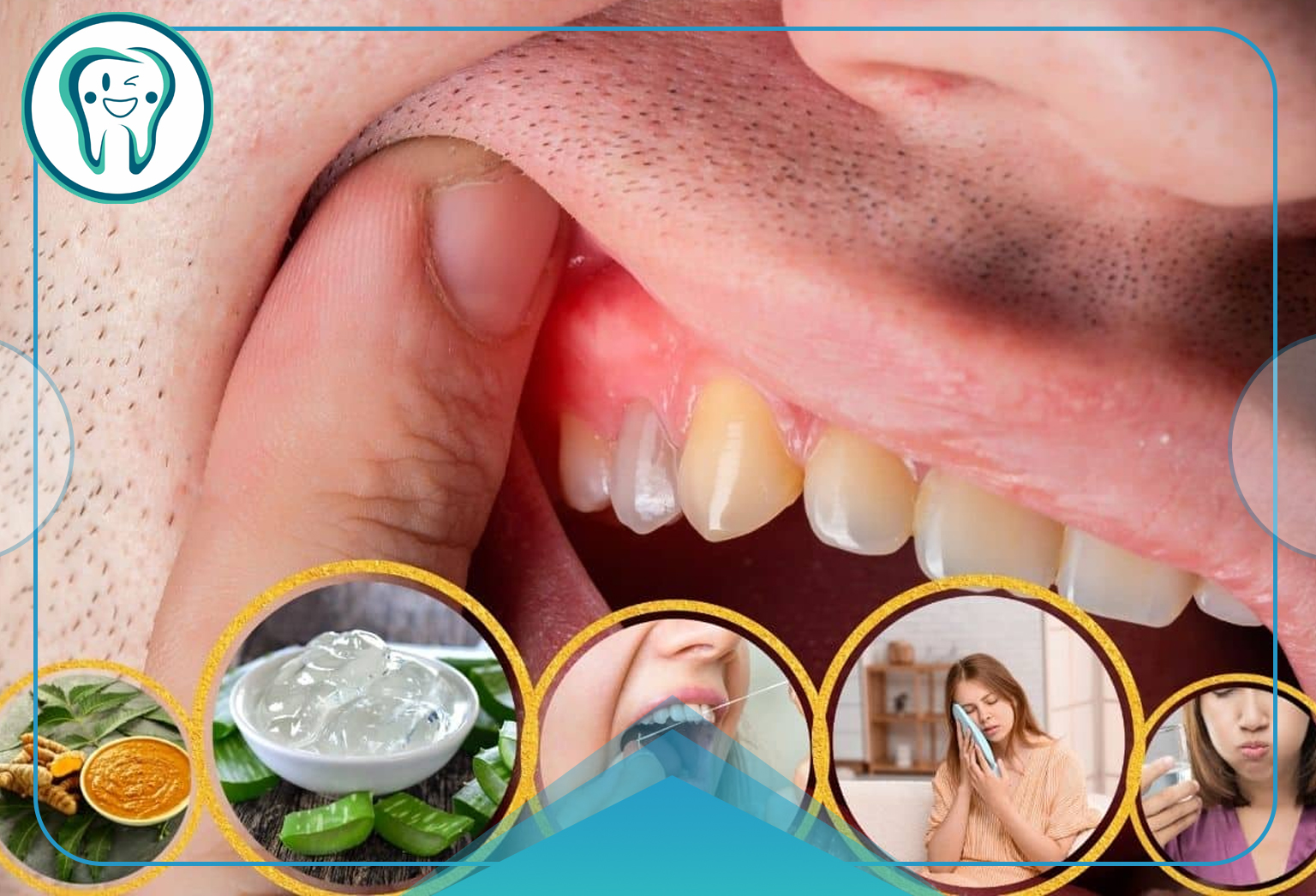 داروی گیاهی برای عفونت لثه و دندان